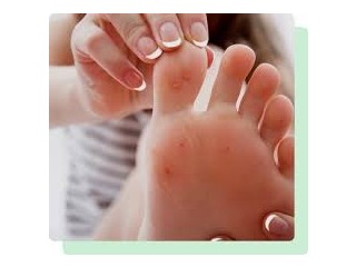 Swift Therapy For Warts Perth Amboy, NJ